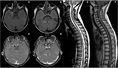 Diagnostic challenge in children with an acquired demyelinating syndrome: an illustrative case report